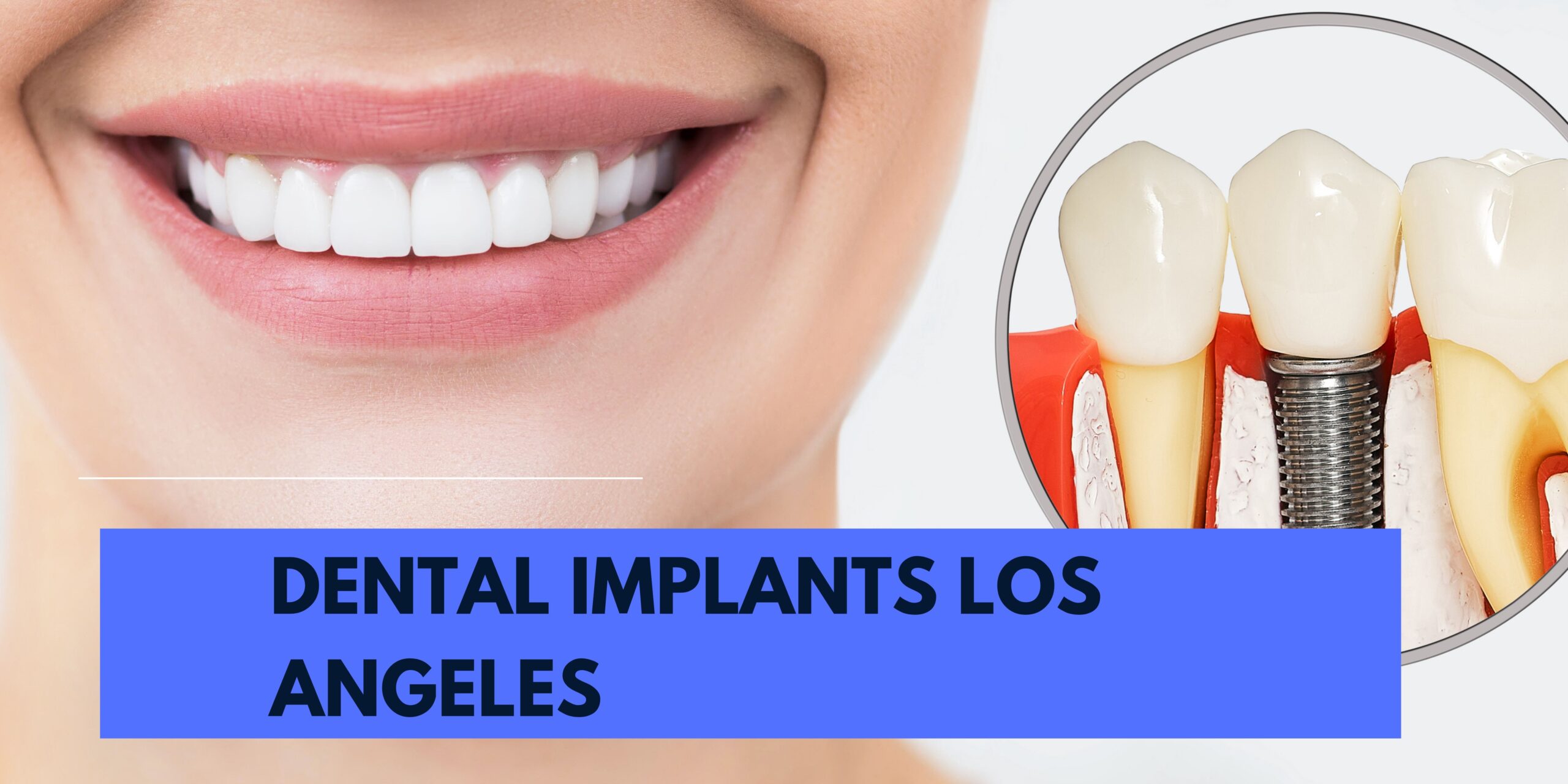 A Brief Idea Of How Dental Implant Restores Your Look